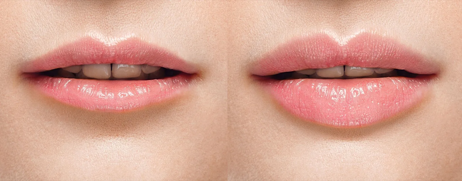 Lip filler before and after results representing Restylane Kysse lip enhancement at Rewind Anti-Aging Miami